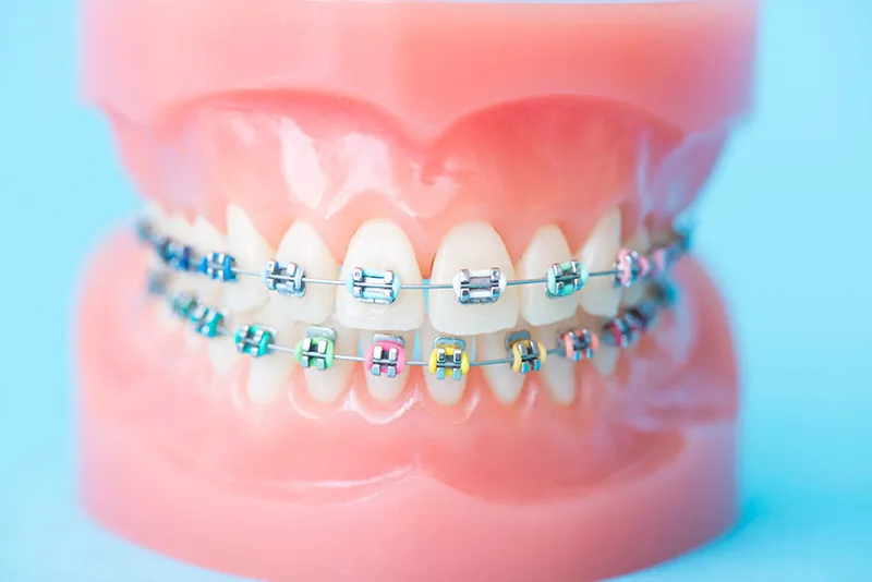歯の矯正について詳しく解説します